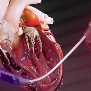 SMH Expands Pacemaker Options for Complex Heart Failure